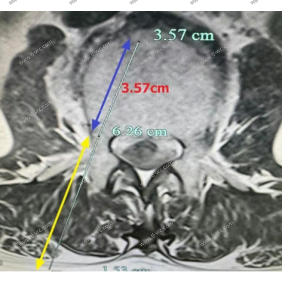 How to handle UBE intervertebral space, UBE intervertebral space preparation, and UBE fusion intervertebral space clearance